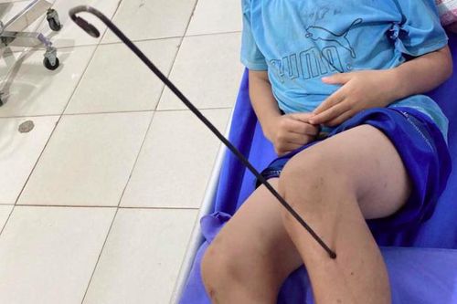 Đang chơi đùa, bé trai bị mũi tên kim loại dài 60cm đâm xuyên chân