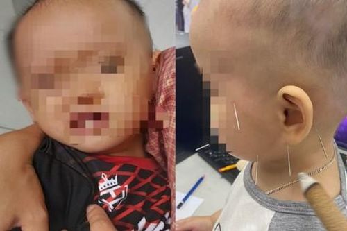 Lời cảnh tỉnh sau vụ bé gái 1 tuổi liệt mặt vì nằm quạt sai cách