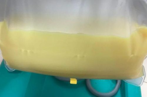 Căn bệnh khiến người đàn ông có huyết tương đục như sữa, phải thay gấp