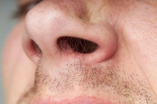 Người đàn ông bị hoại tử mũi vì mắc đậu mùa khỉ