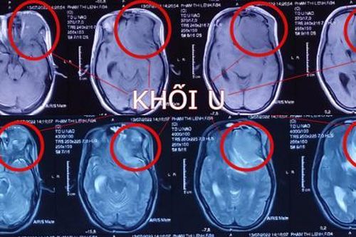 9 giờ 'cân não' cứu thai phụ u não hôn mê, nguy kịch