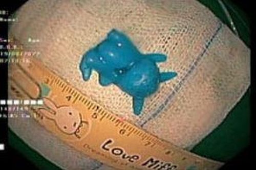 Pikachu đồ chơi kẹt trong thực quản em bé