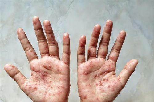 Số ca mắc bệnh đậu mùa khỉ ở Israel lên đến hơn 200 người