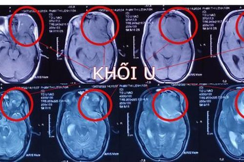 Thai phụ 22 tuần có khối u não lớn