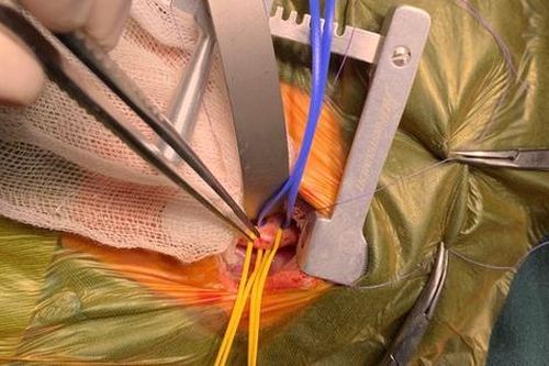 Đại phẫu cứu bệnh nhi 10 ngày tuổi, nặng 1,9kg