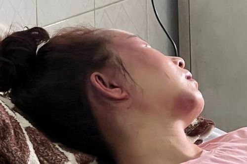 Vụ cán bộ QLTT đánh cô gái dã man: Nạn nhân phải phẫu thuật và theo dõi thêm phần não