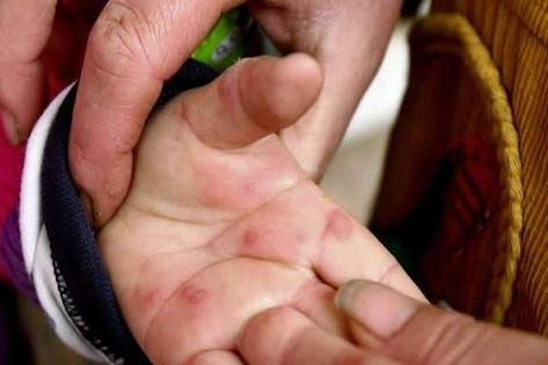 Ấn Độ cảnh báo xuất hiện loại virus mới gây bệnh 'cúm cà chua'