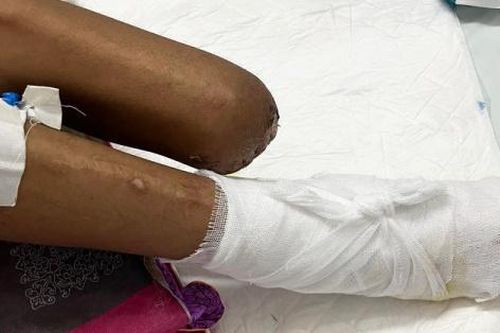 Nhiều trường hợp bị cắt cụt chi do bỏng điện