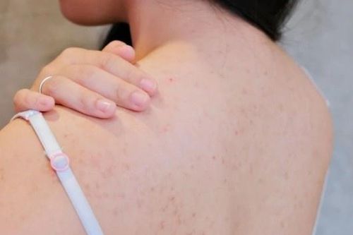 Ngộ độc thuốc gây tê, suýt tử vong vì trị mụn lưng tại spa