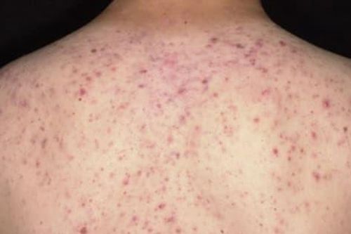 Trị mụn trứng cá ở lưng, một phụ nữ bị sốc phản vệ nguy kịch