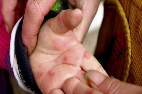 Ấn Độ gia tăng ca mắc biến thể virus 'cúm cà chua', lo ngại bùng phát