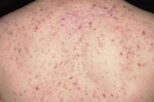 Lăn kim trị mụn lưng người phụ nữ 36 tuổi suýt tử vong: Bác sĩ khuyến cáo