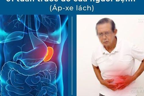 Áp-xe lách – bệnh lý rất nguy hiểm nhưng hiếm gặp đến mức bị…lãng quên