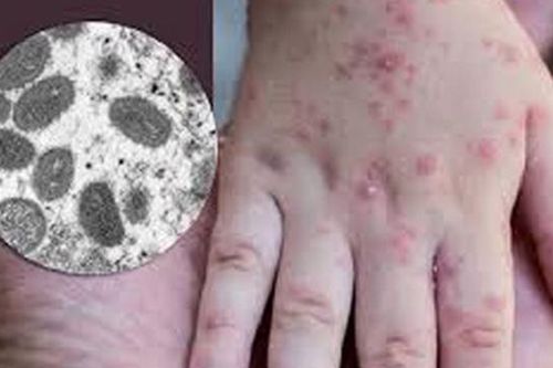 Cách phòng ngừa lây nhiễm bệnh đậu mùa khỉ tại cơ sở y tế