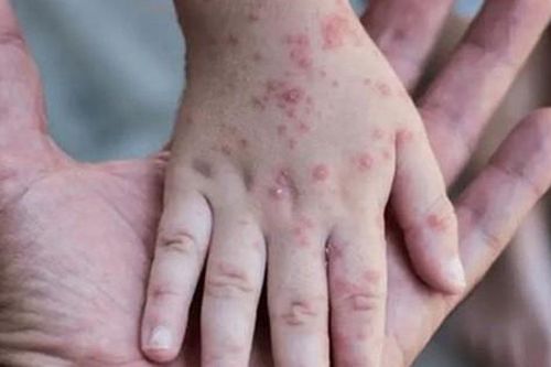 Người châu Âu vượt biên để tiêm chủng đậu mùa khỉ
