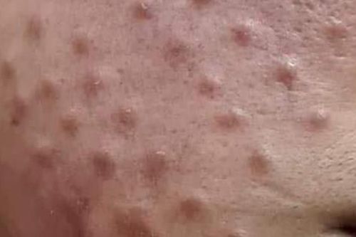Da nổi u hạt sau khi tiêm mesotherapy bằng hoạt chất không rõ nguồn gốc