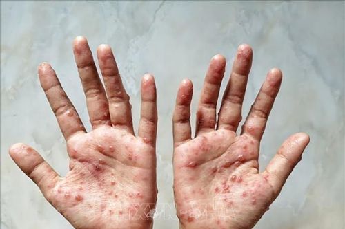 Brazil cấp phép sử dụng vaccine Jynneos để ứng phó bệnh đậu mùa khỉ