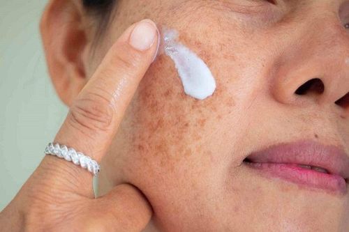 Phát hiện kem trị nám có hàm lượng thủy ngân vượt ngưỡng