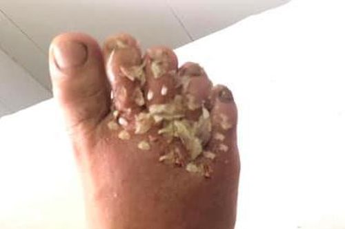 Đi viện cấp cứu vì đắp tỏi chữa vết thương rết cắn