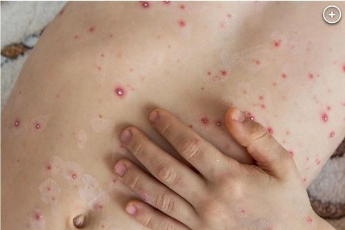 Bệnh cúm cà chua chưa có vắc-xin và thuốc đặc trị