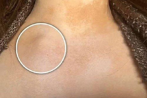 Tưởng mệt mỏi vì học hành, cô gái 21 tuổi không ngờ mắc ung thư