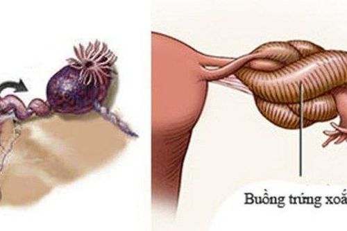 Nữ bệnh nhân 43 tuổi bị u buồng trứng xoắn 3 vòng