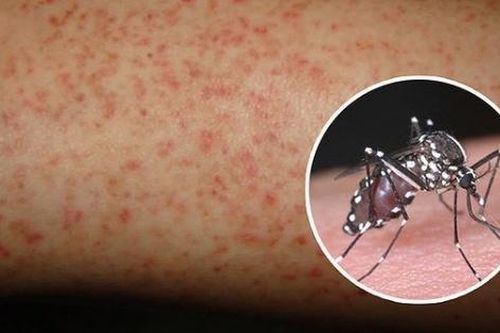 Lưu ý khi chăm sóc bệnh nhân mắc sốt xuất huyết
