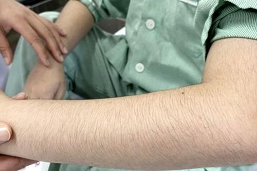 Báo động suy tuyến thượng thận do dùng thuốc xịt mũi, thuốc đông y chứa corticoid