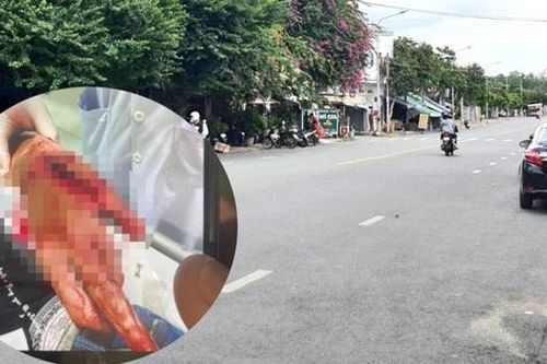 Bị chém nhập viện vì làm rơi tai nghe điện thoại của cô gái