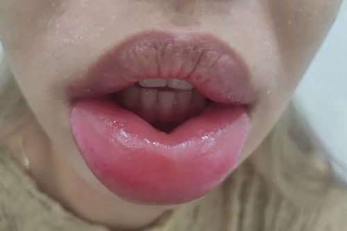 Tốn 3,5 triệu đồng tiêm filler, người phụ nữ 35 tuổi nhận về kết quả môi nề, có khối căng cứng