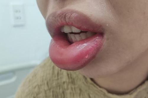 Cô gái nhập viện vì 'cặp môi cá ngão' sau khi làm đẹp