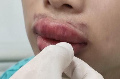 Môi sưng phồng, bầm tím sau khi tiêm filler xóa nhăn