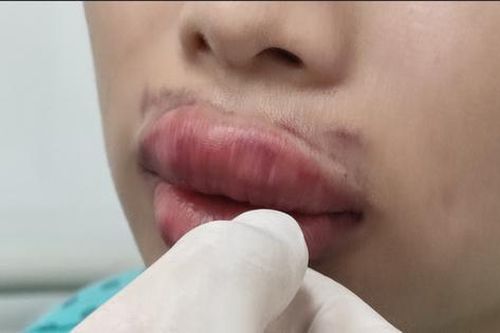 Môi sưng phồng căng cứng sau tiêm chất làm đầy