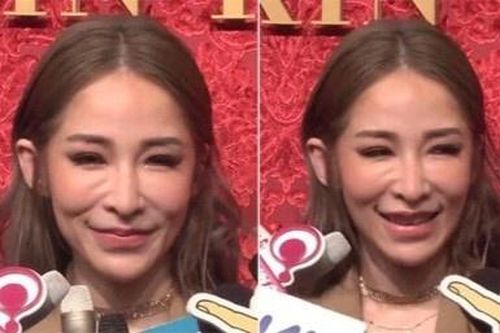 Ám ảnh với botox, filler