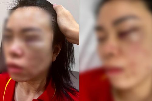 Nghi án người phụ nữ bị chồng cũ đánh đập trong nhiều giờ