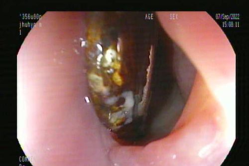 Bé trai 11 tháng tuổi nuốt cục pin vào thực quản
