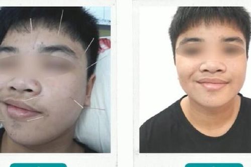 Bệnh 'khẩu nhãn oa tà' khiến nam sinh bất ngờ liệt nửa mặt