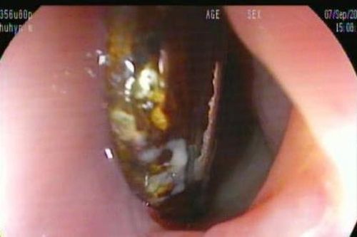 Cứu sống bé trai 11 tháng tuổi hóc cục pin