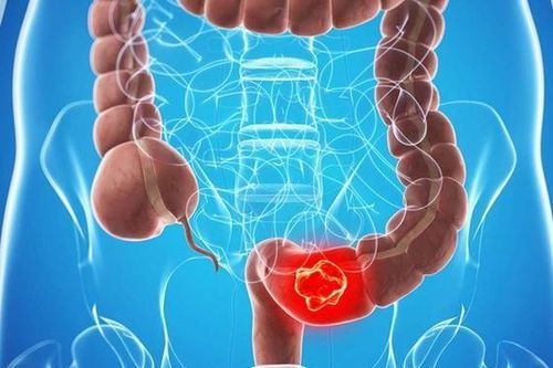 Vì sao cần tầm soát ung thư đại trực tràng sớm?