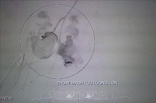 10 phút nút mạch, cứu sống bệnh nhân bị đa chấn thương nguy kịch