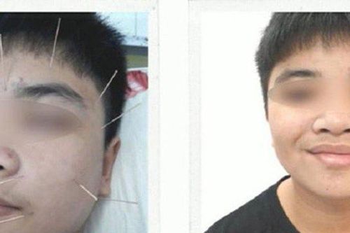 Nam sinh lớp 10 liệt nửa mặt vì trúng 'khẩu nhãn oa tà'