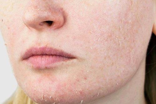 Nắng đã bớt gắt hơn nhưng vì sao tình trạng da của bạn vẫn không tốt lên