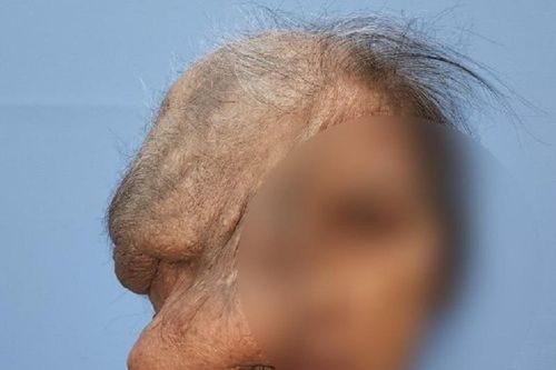 Phẫu thuật cho cụ bà bị khối u quá lớn che hết khuôn mặt, ăn vào mắt, xương sọ