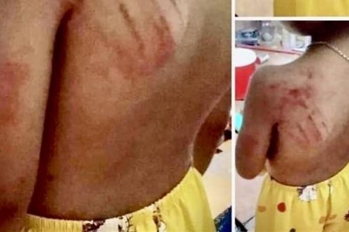 Bà Rịa- Vũng Tàu: Một học sinh lớp 2 bị giáo viên 'dạy quá tay'