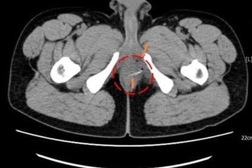 Người đàn ông bị xương cá đâm thủng thành ruột