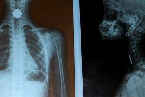 2 việc cần làm ngay khi trẻ bị hóc dị vật