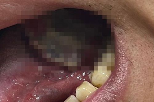 Tưởng nhiệt miệng, đi khám phát hiện ung thư lưỡi giai đoạn 4