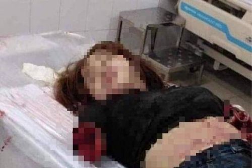 Khởi tố, bắt tạm giam người chồng chém lìa 2 tay vợ do ghen tuông