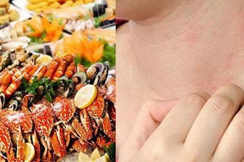 Từ vụ sốc phản vệ khi ăn cua biển, chuyên gia chỉ rõ người có dấu hiệu này thèm mấy cũng không nên ăn