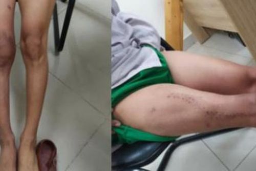 Ngâm xương trong Ni-tơ lạnh, cứu đôi chân chiến sĩ trẻ bị ung thư